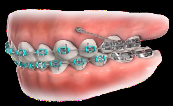 تصویر 4 از اورینگ ارتودنسی در رنگ بندی متنوع با کیفیت عالی
